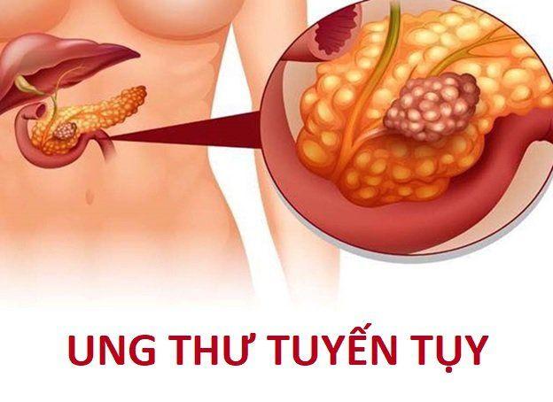 ung-thu-tuyen-tuy.jpg