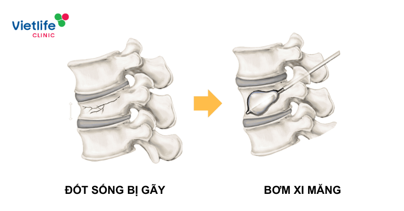 Bơm xi măng cột sống là gì