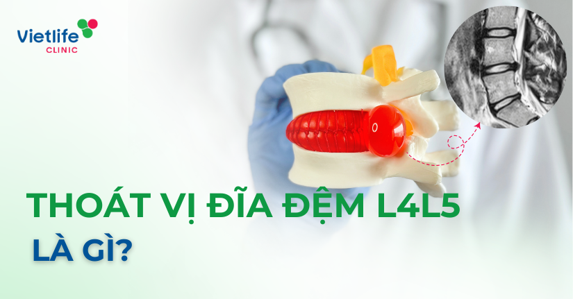 Thoát vị đĩa đệm L4L5 là gì?