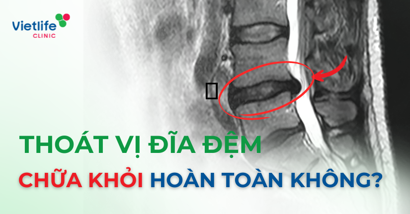 Thoát vị đĩa đêm có chữa khỏi hoàn toàn không?