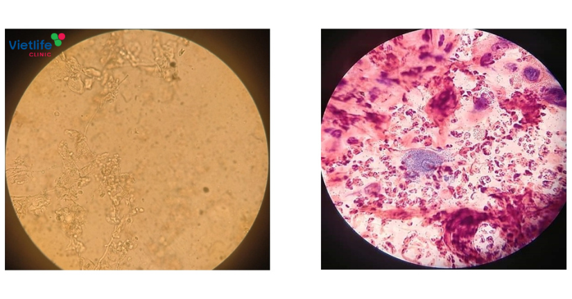 Xét nghiệm soi tươi dịch tử cung