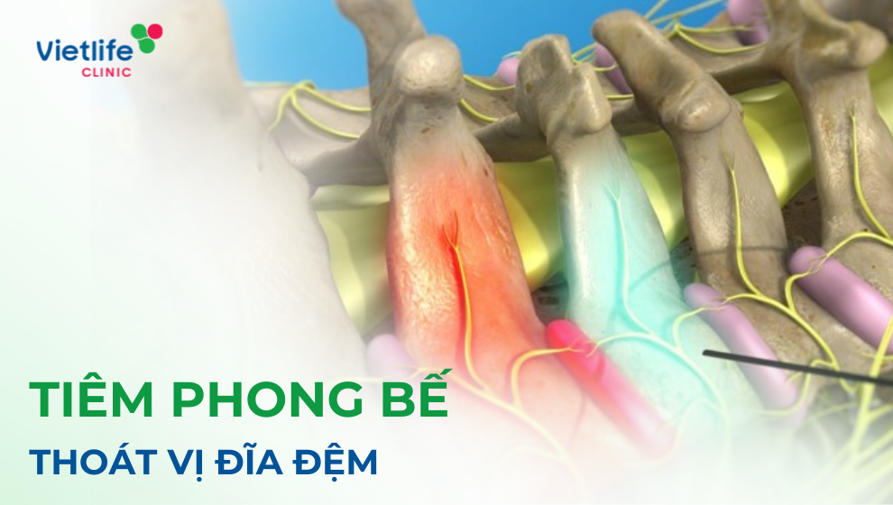 Tiêm phong bế thoát vị đĩa đệm