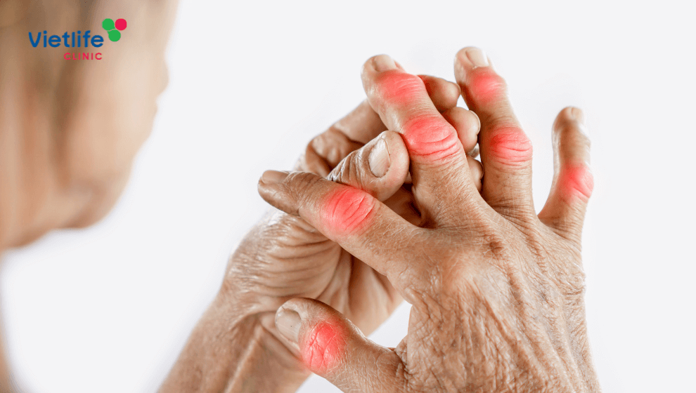 Bệnh gout là gì